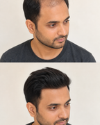 Australian Front Lace Hair Patch for Men, Durable Base - before and after result